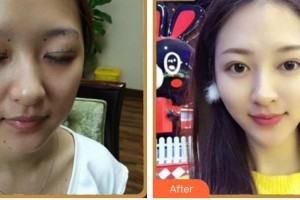 廈門(mén)大學(xué)附屬?gòu)B門(mén)眼科中心醫(yī)院張淳整形價(jià)格表附眼部多項(xiàng)案例展示