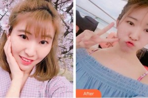 廈門(mén)大學(xué)附屬?gòu)B門(mén)眼科中心醫(yī)院李煒整形價(jià)格表附切開(kāi)雙眼皮案例展示