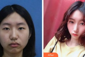 廈門(mén)大學(xué)附屬?gòu)B門(mén)眼科中心醫(yī)院李立梅整形價(jià)格表附上瞼微整案例展示