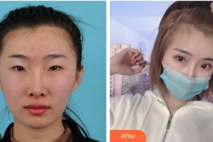 廈門(mén)大學(xué)附屬?gòu)B門(mén)眼科中心醫(yī)院任小軍整形價(jià)格表附全切雙眼皮+開(kāi)內(nèi)眼角+開(kāi)外眼角案例展示