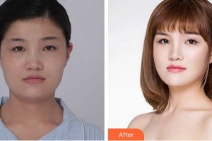 廈門(mén)大學(xué)附屬?gòu)B門(mén)眼科中心醫(yī)院何雪洪整形價(jià)格表附眼部綜合日記案例展示