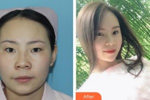 廈門(mén)大學(xué)附屬?gòu)B門(mén)眼科中心醫(yī)院楊麗杰整形價(jià)格表附精細(xì)切開(kāi)雙眼皮案例展示