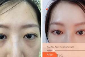 廈門(mén)大學(xué)附屬?gòu)B門(mén)眼科中心醫(yī)院許亞章整形價(jià)格表附內(nèi)路去眼袋案例展示