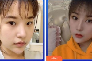 廈門(mén)大學(xué)附屬?gòu)B門(mén)眼科中心醫(yī)院王晶整形價(jià)格表附切開(kāi)重瞼伴提肌+內(nèi)眥開(kāi)大術(shù)案例展示