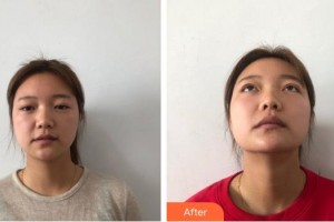 廈門大學附屬廈門眼科中心醫(yī)院王晶整形價格表附美眼部手術案例展示