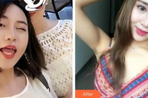 廈門大學附屬廈門眼科中心醫(yī)院王樂整形價格表附雙眼皮案例展示