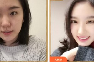 廈門大學附屬廈門眼科中心醫(yī)院李孟瓊整形價格表附眼部綜合案例展示