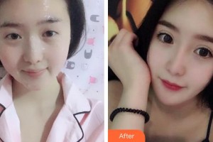 廈門大學附屬廈門眼科中心醫(yī)院周山整形價格表附眼部綜合案例展示