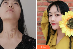 廣州愛(ài)來(lái)（原阿瑪施）醫(yī)療美容整形醫(yī)院唐福麟整形價(jià)格表附燙傷疤痕修復(fù)案例展示