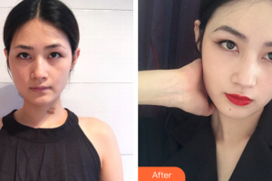 廣州鴻業(yè)醫(yī)學(xué)美容門(mén)診部巫勝君整形價(jià)格表附增生疤痕案例展示