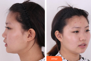 廣州鴻業(yè)醫(yī)學(xué)美容門(mén)診部羅良俊整形價(jià)格表附鼻部綜合案例展示