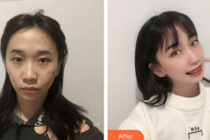 廣州鴻業(yè)醫(yī)學(xué)美容門(mén)診部劉相勇整形價(jià)格表附縫針疤痕案例展示