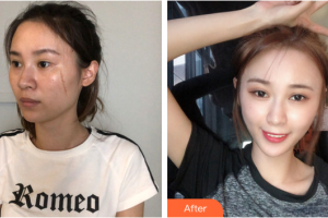 廣州鴻業(yè)醫(yī)學(xué)美容門(mén)診部陳杏整形價(jià)格表附點(diǎn)陣激光去痘印痘坑案例展示