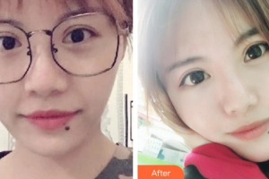 廣州廣大整形美容醫(yī)院任生整形價(jià)格表附自體脂肪填充案例展示