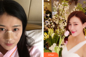 廣州中科美整形醫(yī)院鄭志敏整形價(jià)格表附鼻部手術(shù)案例展示