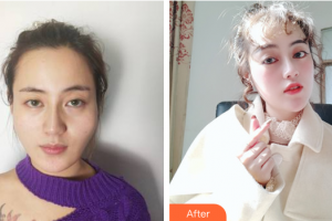 廣州廣大整形美容醫(yī)院于曉強(qiáng)整形價(jià)格表附顴骨顴弓整形術(shù)	案例展示