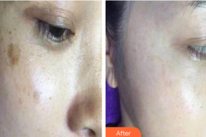 南方醫(yī)科大學(xué)附屬?gòu)V州燕嶺醫(yī)院整形美容中心郭芳整形價(jià)格表附激光祛色素沉著疤痕案例展示