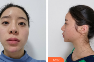 廣州博仕整形美容醫(yī)院蔡偉平整形價(jià)格表附切開(kāi)雙眼皮案例展示