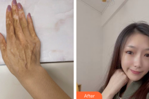 廣州瑞港醫(yī)療美容門診部陳中海整形價(jià)格表附傷燙傷疤痕案例展示