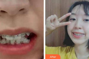 廣州瑞港醫(yī)療美容門診部王正云整形價(jià)格表附牙齒矯正案例展示