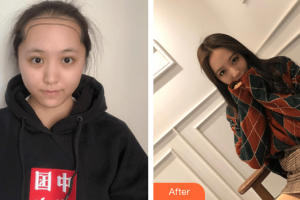 廣州壹加壹美容醫(yī)院胡準(zhǔn)整形價(jià)格表附發(fā)際線種植案例展示