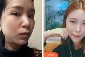 廣州瑞港醫(yī)療美容門診部肖醫(yī)生整形價(jià)格表附發(fā)際線種植案例展示