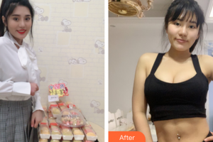 廣州麗尚整形美容門診部王華軍整形價(jià)格表附全身吸脂案例展示