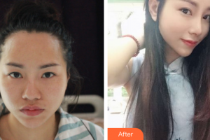 廣州美恩整形美容醫(yī)院南華整形價(jià)格表附肋軟骨隆鼻案例展示