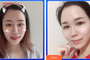 廈門大學附屬廈門眼科中心醫(yī)院李東侃整形價格表附眼部案例展示