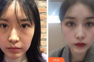 廈門大學附屬廈門眼科中心醫(yī)院林淑玲整形價格表附眼修復案例展示