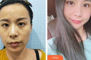 廈門大學附屬廈門眼科中心醫(yī)院徐法松整形價格表附上瞼提肌案例展示