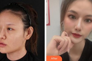 廈門大學附屬廈門眼科中心醫(yī)院徐靜靜整形價格表附眼部案例展示