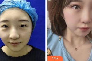 廈門大學附屬廈門眼科中心醫(yī)院毛益輝整形價格表附美眼/大眼看未來案例展示