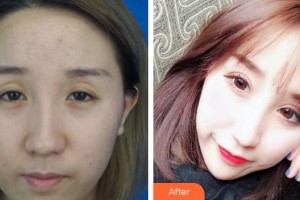 廈門大學附屬廈門眼科中心醫(yī)院歐陽文博整形價格表附切開雙眼皮案例案例展示