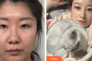 廈門大學附屬廈門眼科中心醫(yī)院商旭敏整形價格表附眼部整形案例展示