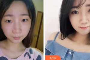 廈門大學附屬廈門眼科中心醫(yī)院葉梅整形價格表附自然雙眼皮案例展示