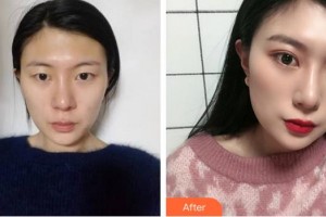 廈門大學附屬廈門眼科中心醫(yī)院付彥敏整形價格表附眼部手術案例展示