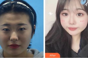 廈門大學附屬廈門眼科中心醫(yī)院羅順榮整形價格表附眼部手術案例展示