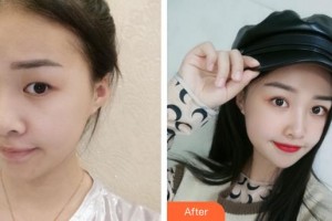 廈門大學附屬廈門眼科中心醫(yī)院莊建福整形價格表附眼部手術案例展示