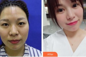 廈門大學附屬廈門眼科中心醫(yī)院陳雙成整形價格表附全切雙眼皮案例展示