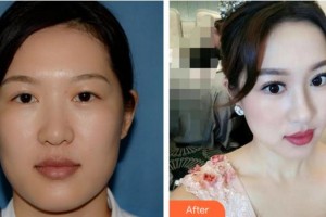 廈門大學附屬廈門眼科中心醫(yī)院謝仁藝整形價格表附雙眼皮修復案例展示