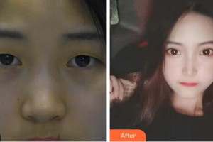 廈門大學附屬廈門眼科中心醫(yī)院陳文生整形價格表附眼部手術案例展示