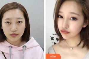 廈門大學附屬廈門眼科中心醫(yī)院何歡整形價格表附變身大眼“氣質(zhì)女孩”案例展示