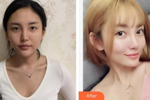 廈門大學附屬廈門眼科中心醫(yī)院楊梅整形價格表附眼部手術案例展示