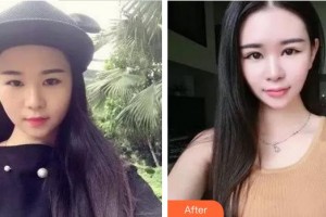 廈門大學附屬廈門眼科中心醫(yī)院沈政偉整形價格表附雙眼皮修復快三個月案例展示