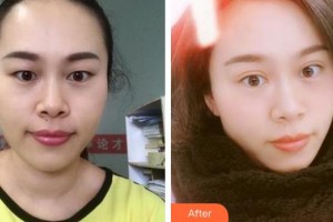 廈門大學附屬廈門眼科中心醫(yī)院王海燕整形價格表附眼部手術案例展示