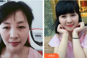 廈門大學附屬廈門眼科中心醫(yī)院揭黎明整形價格表附雙眼皮案例展示