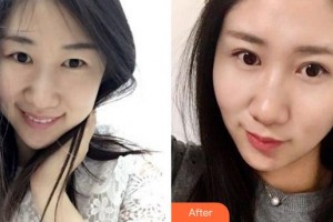 廈門大學附屬廈門眼科中心醫(yī)院胡繼發(fā)整形價格表附眼部綜合案例展示