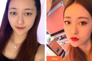 廈門大學(xué)附屬廈門眼科中心醫(yī)院龔頌建整形價格表附玫瑰花雨的雙眼皮案例展示