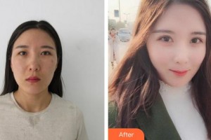 廈門大學(xué)附屬廈門眼科中心醫(yī)院李勇整形價格表附眼部綜合案例展示